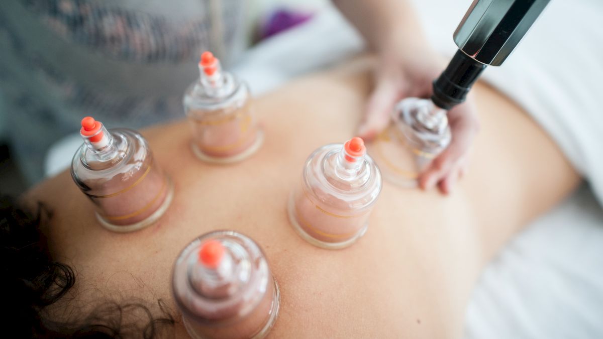 Cupping therapy in progress on a person's back with several cups applied.